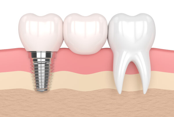 Zirconia dental implants